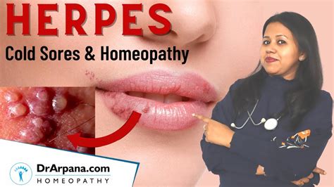 HERPES SIMPLEX VIRUS Symptoms Homeopathic Treatment HSV 1 HSV 2