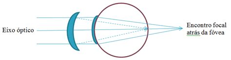 Hipermetropia O Que Sintomas E Tratamento Consultor Ptico