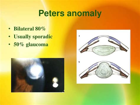 PPT - The Congenital ( (Developmental Glaucomas PowerPoint Presentation ...