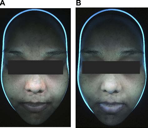 Figure From Comparative Study Of Photodynamic Therapy With Riboflavin