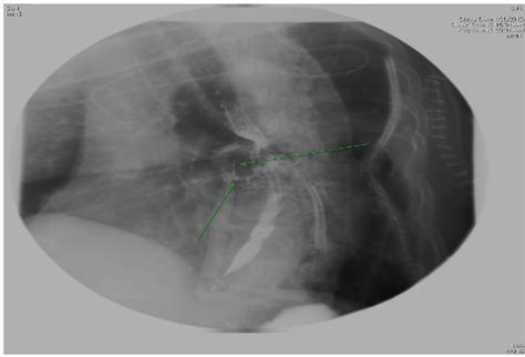 Figure 2 From Management Of Atrio Esophageal Fistula Following Left