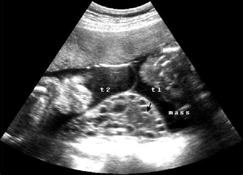 Ultrasound At 20 Weeks Of Gestation Revealed Two Live Fetuses And One