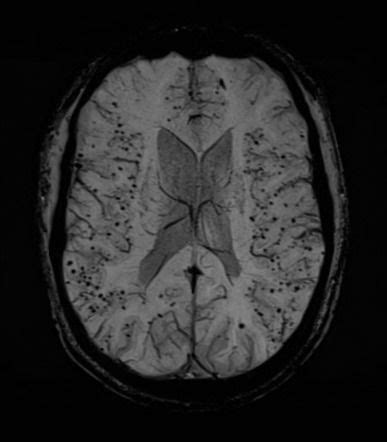 Cerebral Amyloid Angiopathy MRI