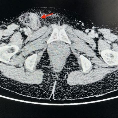 Axial Cect Image Showing Right Femoral Hernia Sac Red Arrow