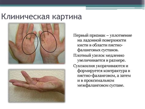 Контрактура дюпюитрена. Лечение коллагеназой - презентация онлайн