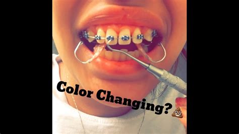 Braces Rubber Band Colors - change comin