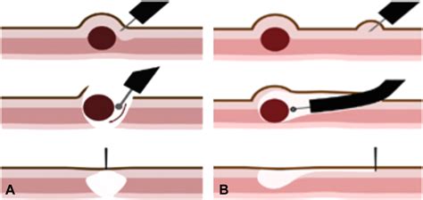 ASGE Guideline For Endoscopic Full Thickness Resection And Submucosal