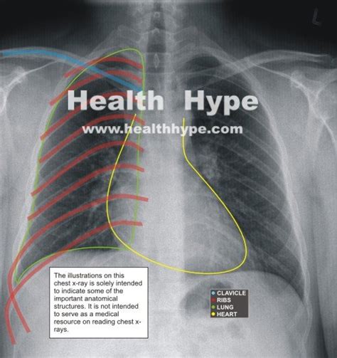 Chest X Ray Guide Abnormalities Of Lung And Heart Diseases