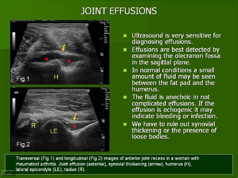 Figure 13 from Ultrasound of the elbow, what the radiologist should ...