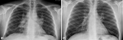 A Chest Radiogram Showing Bilateral Hilar Enlargement Before