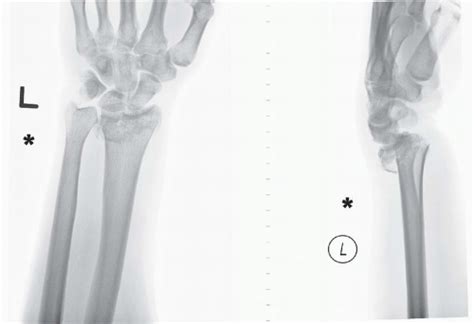 Intra Articular Distal Radius Fracture Types