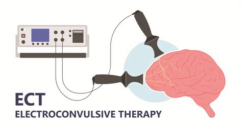 Electroconvulsive Therapy Teknik Indikasi Komplikasi Pedoman