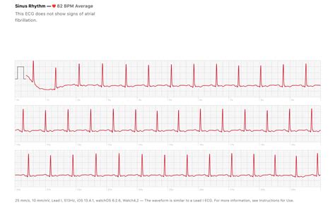 Does this ECG show inverted T-Waves? : r/AppleWatchECG