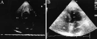 L Fflers Syndrome Pulmonary Vein And Transmitral Doppler Flow