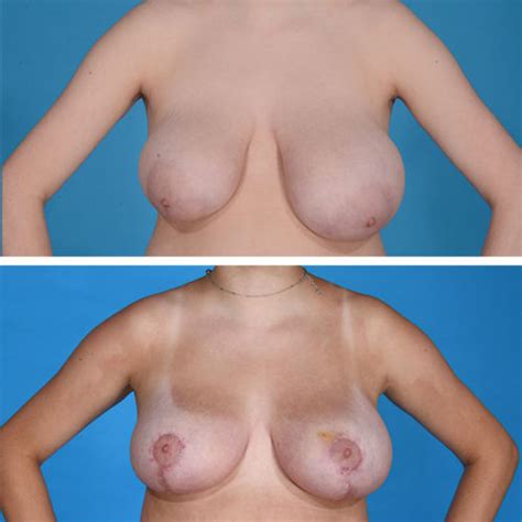 Breast Reduction Dr Jeffrey Lisiecki