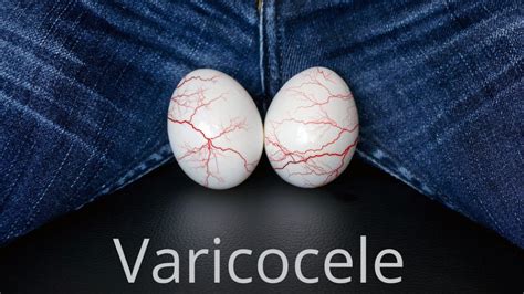 Varicocele El Doloroso Padecimiento Que Podría Afectar La Fertilidad