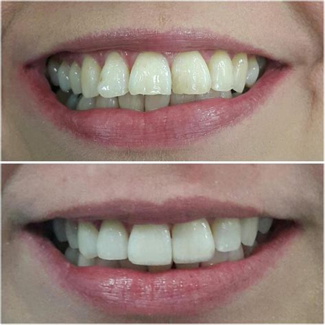 Diferencias Entre Ortodoncia Y Dise O De Sonrisa Premium Dental