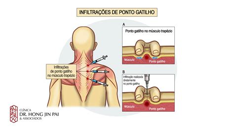 S Ndrome Dolorosa Miofascial Causas Sintomas Tratamentos Cl Nica