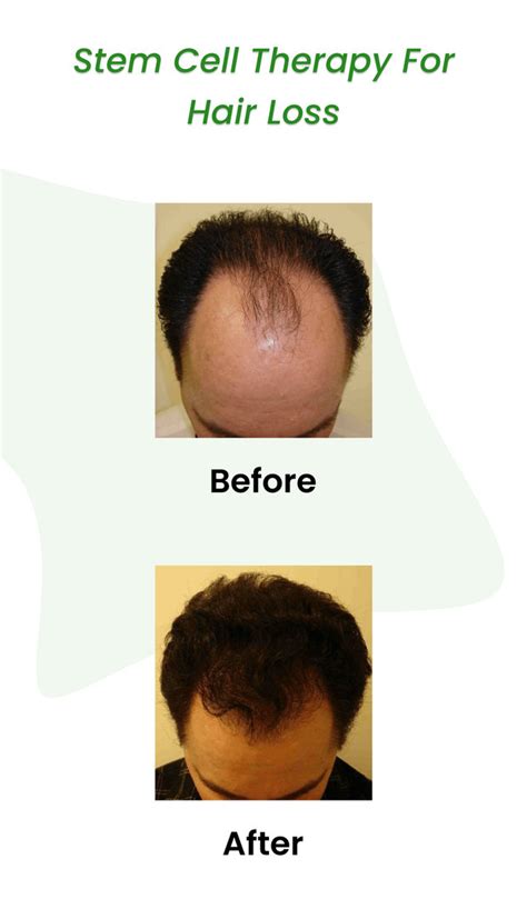 Stem Cell Therapy For Hair