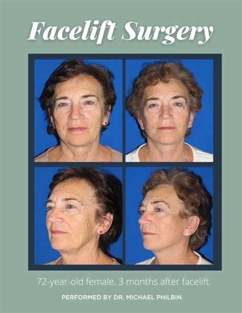 Your Week Facelift Recovery Guide Edina Plastic Surgery