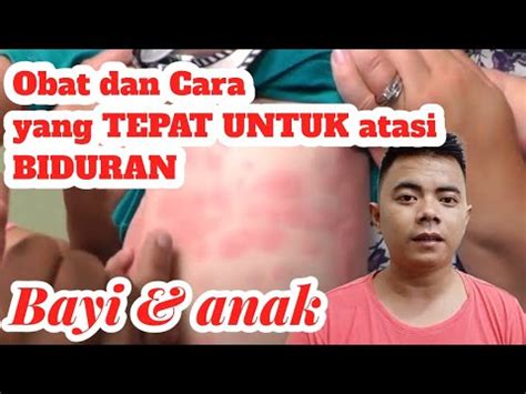 Cara Mengatasi Biduran Pada Bayi Obatbiduranbayi YouTube