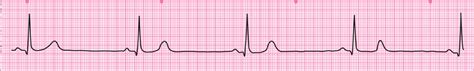 Ecg Interpretation