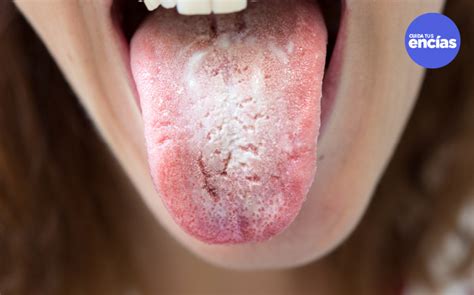 Candidiasis Oral Qu Es Y Qu Me Produce Cuida Tus Enc As Cuida