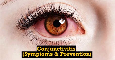 Conjunctivitis Pink Eye Symptoms How To Prevent