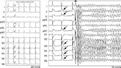 Early Repolarization Syndrome: Epidemiology, Genetics, and Risk ...