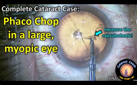 Complete Case Phaco Chop In Myope Cataract Coach