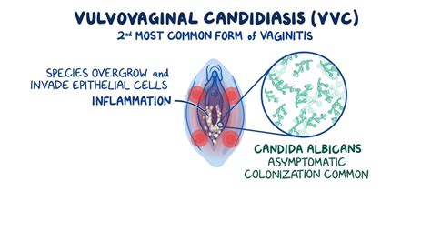 Vulvovaginal Candidiasis Clinical Sciences Osmosis Video Library