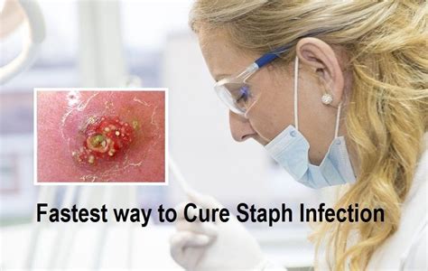 3 Fastest way to Cure Staph Infection