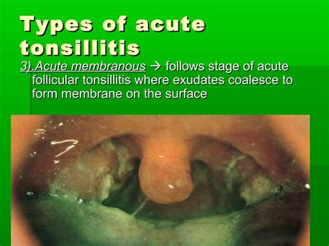 Acute And Chronic Tonsillitis And Their Management Ppt