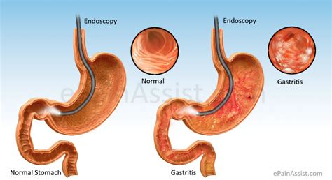 Gastritis is a condition of inflammation of the stomach lining.