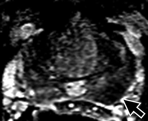 Combined T2 Weighted And Diffusion Weighted MRI For Localization Of