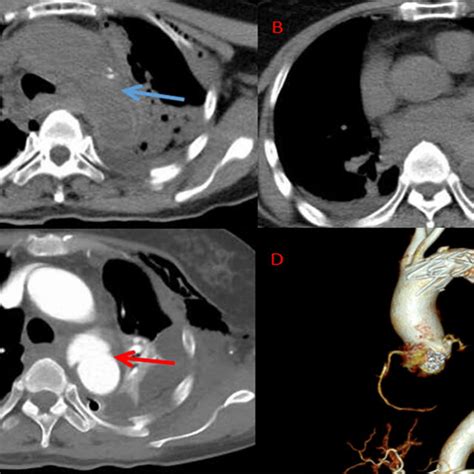 Imaging Scan Of Case A B A Plain Ct Scan Of The Chest Indicated A