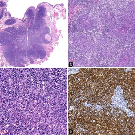 Lymphoepithelial Opscc P16 Positive A A Predominantly Download Scientific Diagram