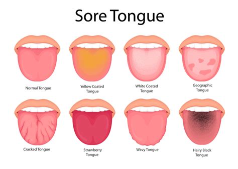 Illustration of tongue symptoms and health. medical illustration ...