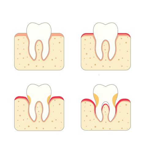 Tooth Periodontal Disease Dental Tartar Human Vector Dental Tartar