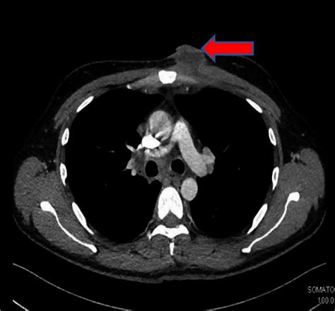 Ct Chest Demonstrating Left Anterior Chest Wall Abscess With Thickened