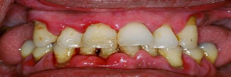 Asymptomatic Apical Periodontitis Causes To Treatment Denta Master