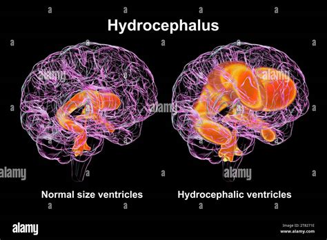 Enlarged And Normal Brain Ventricles Illustration Stock Photo Alamy