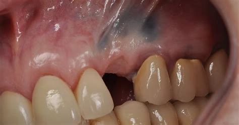 Dental Amalgam Tattoo Imgur