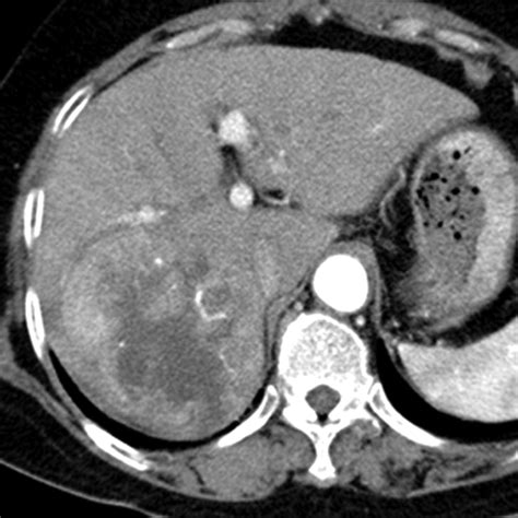 Hepatocellular Carcinoma Variants Radiologic Pathologic Correlation Ajr