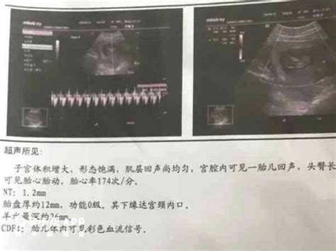 Nt检查报告单各项指标解读，3分钟看懂宝宝正常与否 名医在线