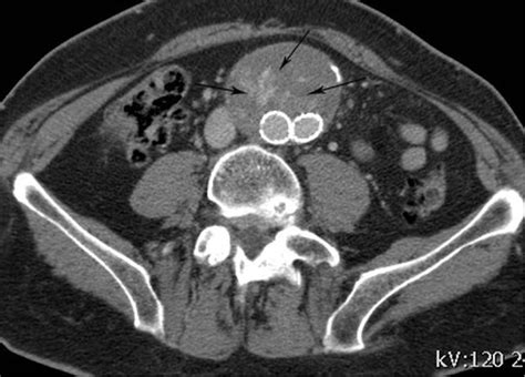 Venous Phase Contrast Enhanced Axial Computed Tomography Image In A