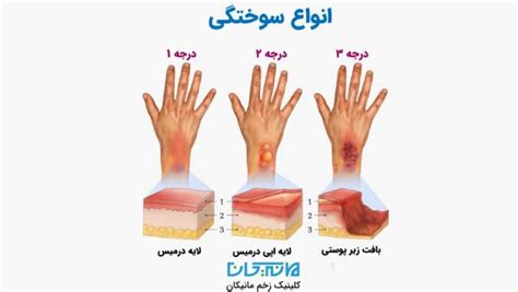 انواع سوختگی کلینیک زخم مانیکان