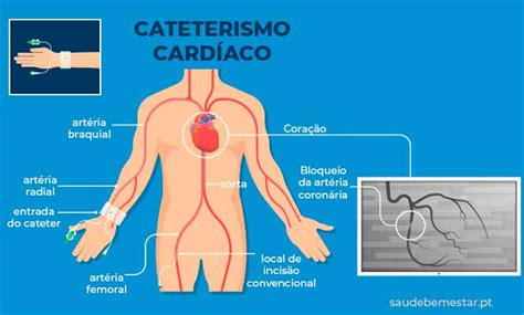 Qu Es Un Cateterismo Cardiaco Off