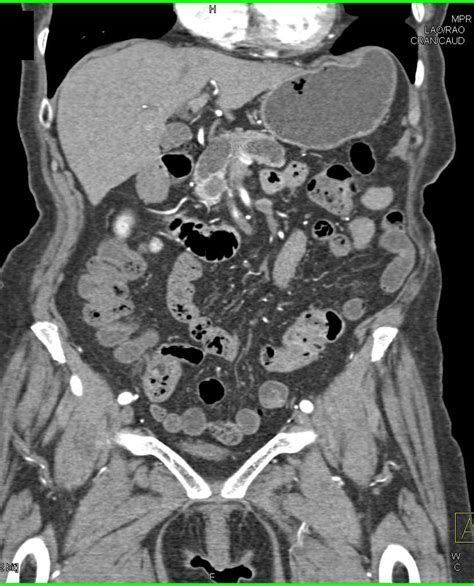 Vascular Muscle Metastases From Renal Cell Carcinoma Musculoskeletal