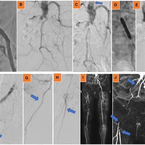 Digital Subtraction Angiography Showed Occlusion Of The Left Common Download Scientific Diagram